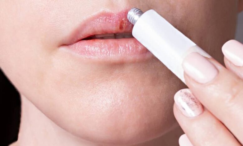 PORTADA Herpes labial