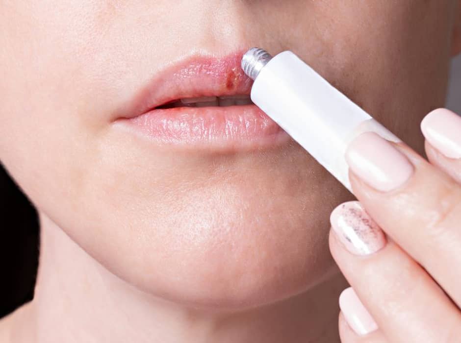 PORTADA Herpes labial
