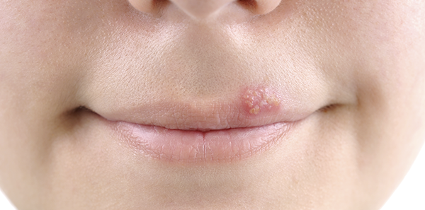 Herpes labial