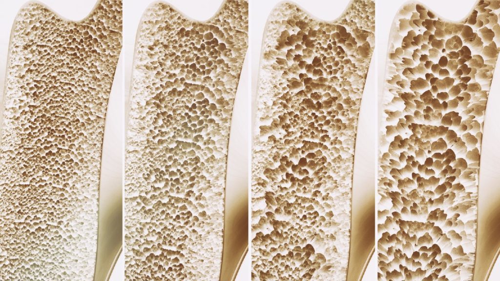 La osteoporosis