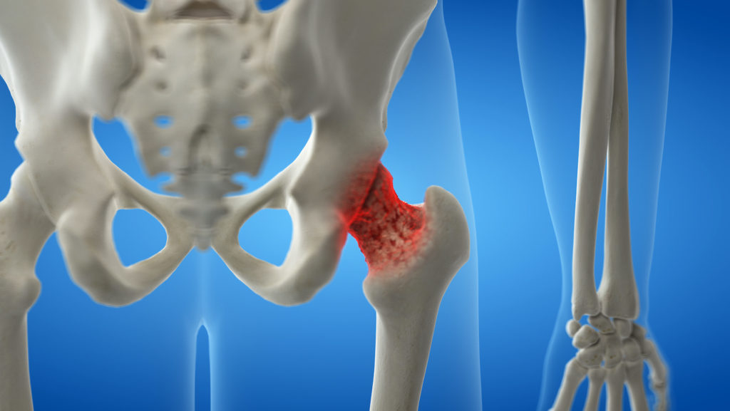 La osteoporosis