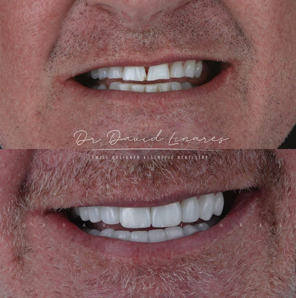 Antes y después de la sonrisa by David Linares