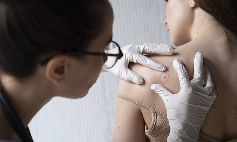 Cuidados y recomendaciones para Varicela