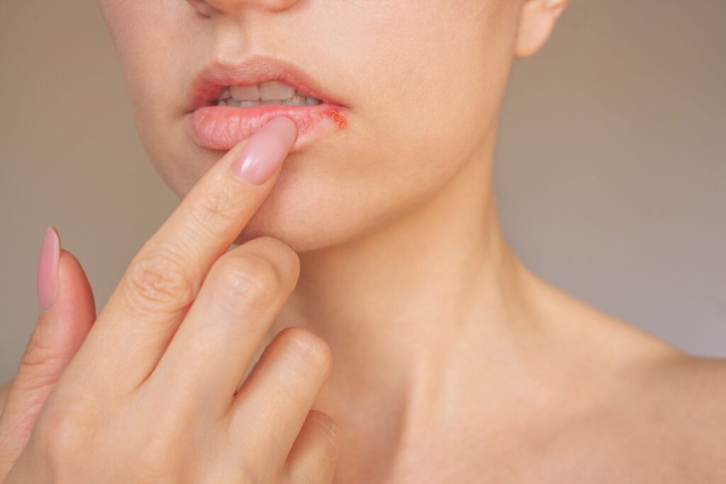 Herpes labial